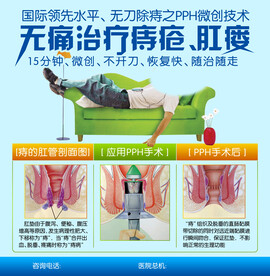 无刀除痔之PPH微创技术