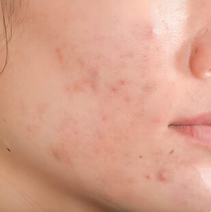 青春痘