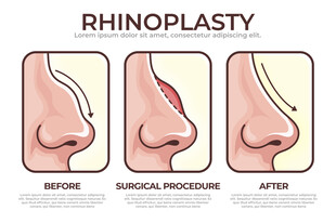 鼻手术前后对比图